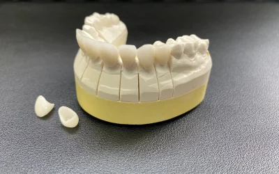 Complete lower crown restoration on cast