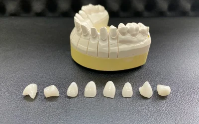 Dental bridge and crowns on stone model.