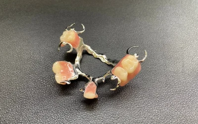 Cast metal partial denture with acrylic teeth