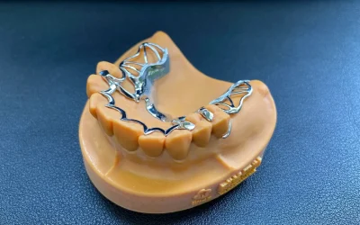 Lower jaw model with cast metal denture