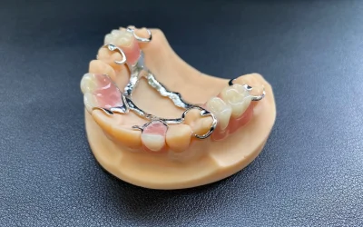 Precision metal partial denture on dental mold