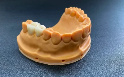 Lower jaw model featuring dental crowns