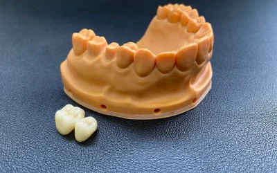 Tooth-colored crowns on molars in jaw model.