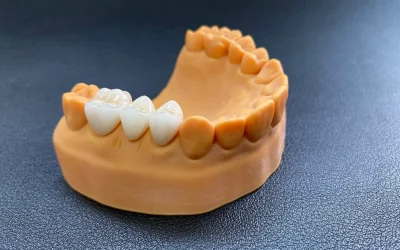Restorative crowns placed on lower dental arch.