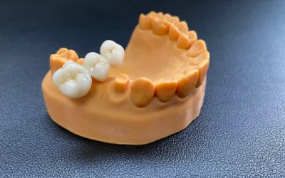 Crown restoration shown on gum model.