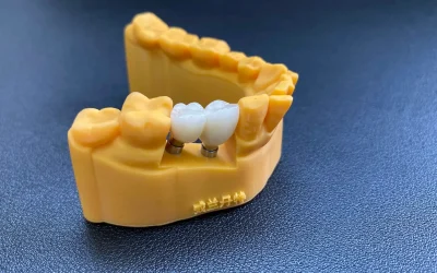 Lower dental cast with prosthetic crowns