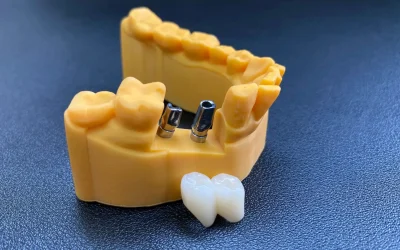 Dental model displaying crown restorations