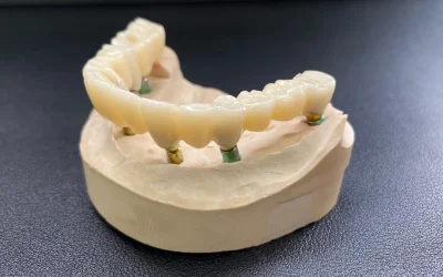 Implant-supported bridge on dental model