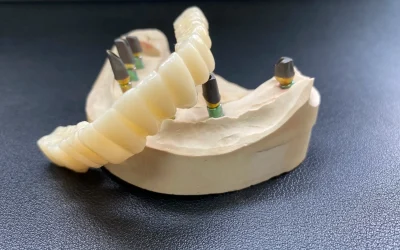 Full-arch crown restoration with implants