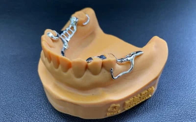 Metal partial denture displayed on gum model