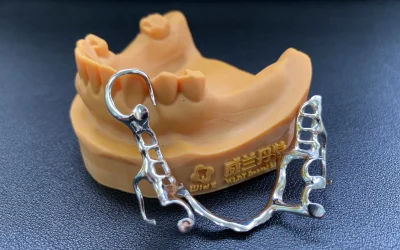 Dental framework for lower partial denture.