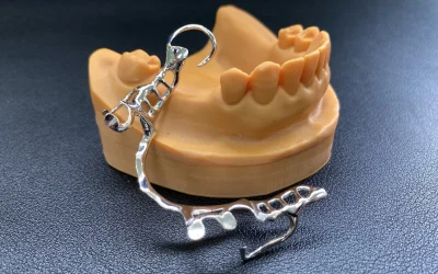 Removable partial denture with metal clasps on a jaw model